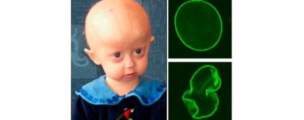 progeria