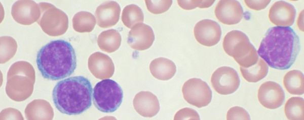 chronische lymfatische leukemie