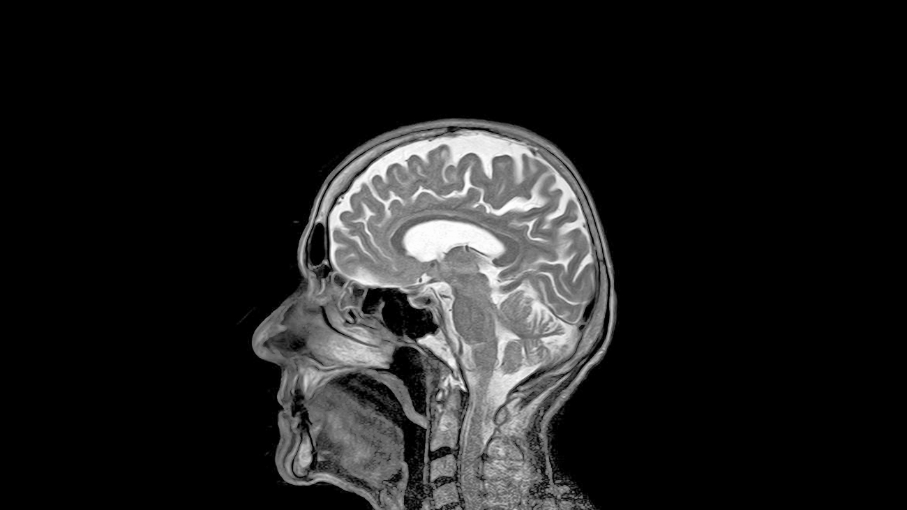 Hersenschudding MRI-scan